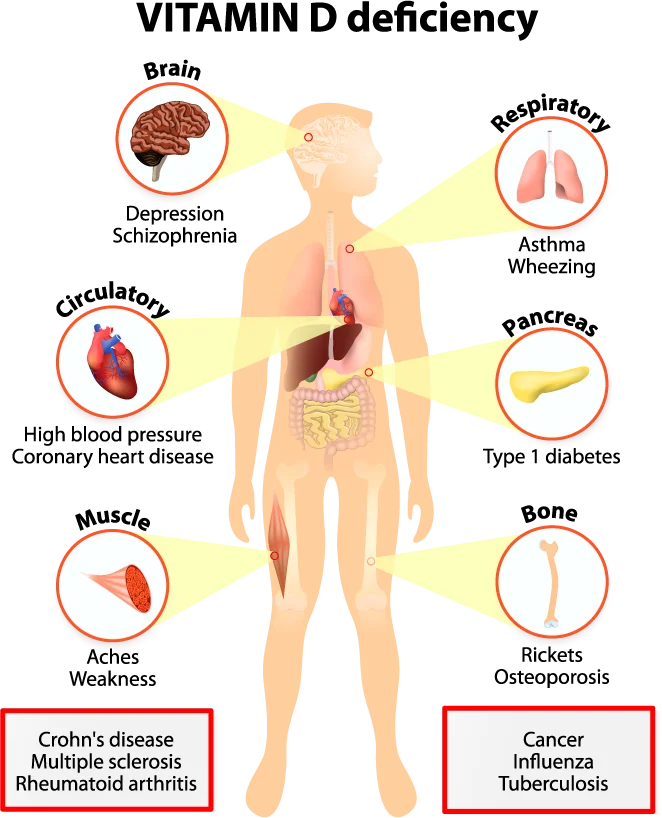 Symptoms of Vitamin D Deficiency